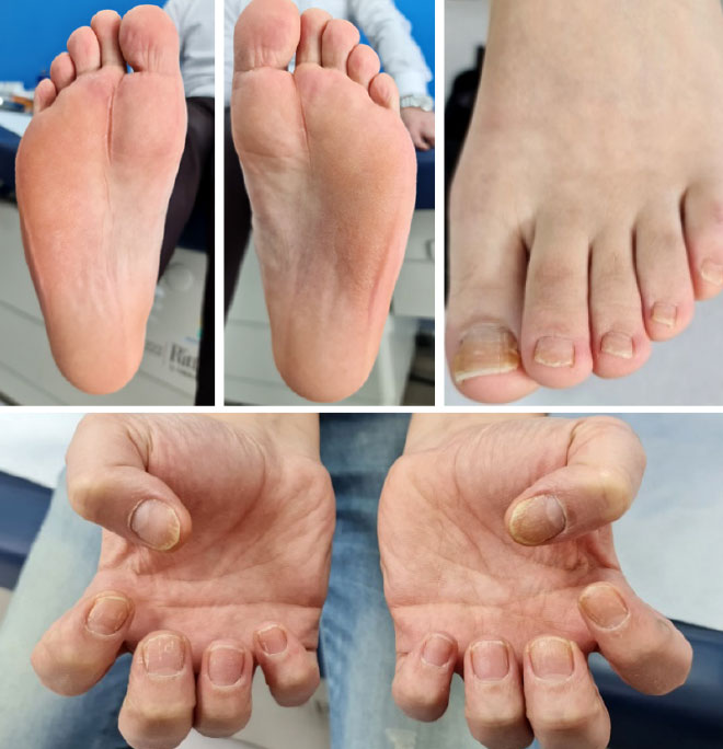 Figure 2. Week 12 Images showing significant improvement of skin lesions and nail psoriasis after ixekizumab therapy
