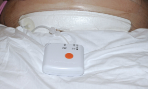 Figure 2. PICO negative wound pressure device in place on Caesarean section wound. Reproduced with permission from Lindsey Bullough, Tissue Viability Nurse, Wrightington, Wigan and Leigh NHS Foundation Trust