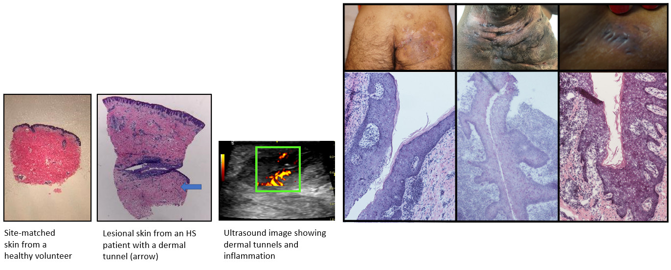 Figure 2. Ultrasonography identifies tunnels in skin from patients with HS